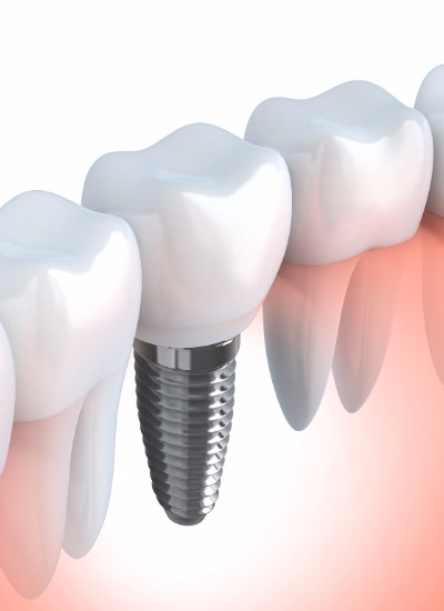 Dental Implants, Thornhill Dentist